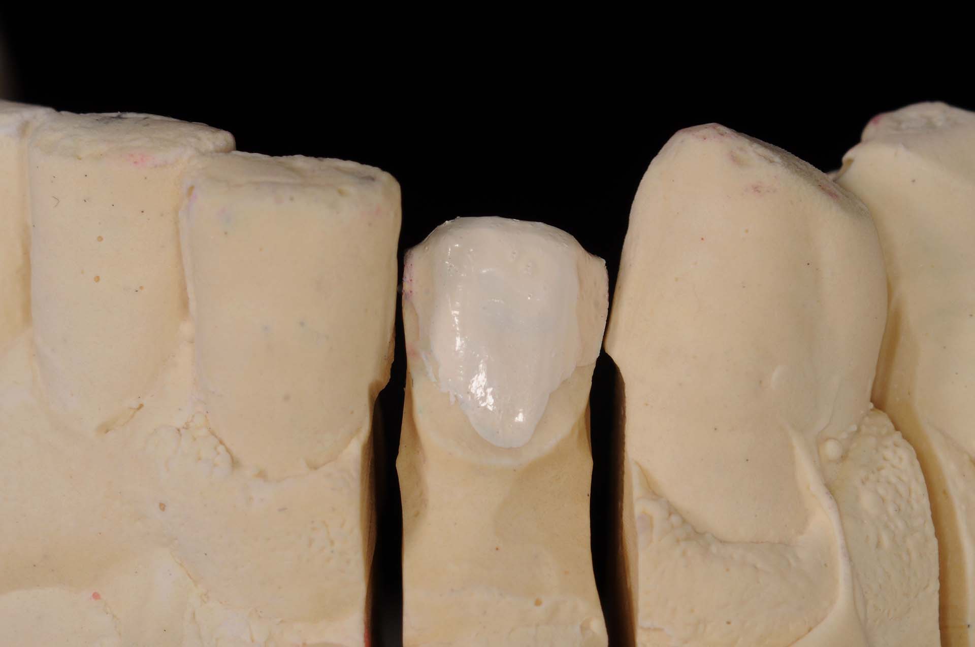 Veneer 32